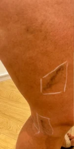 Leg thread veins on the thigh marked out before laser vein removal at Bell Moon Aesthetics, London