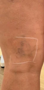 Spider veins behind the knee marked for laser treatment at Bell Moon Aesthetics in Mayfair