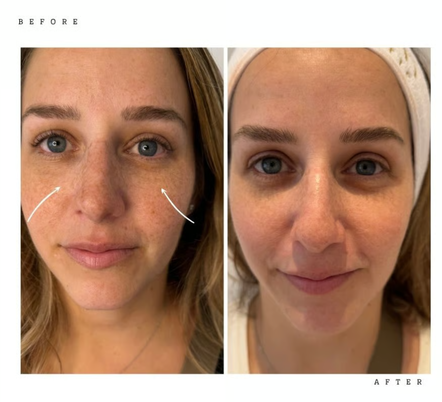 Before and after pigmentation treatment at Bell Moon Aesthetics, front view: freckling and brown pigment across the cheeks and nose visibly reduced