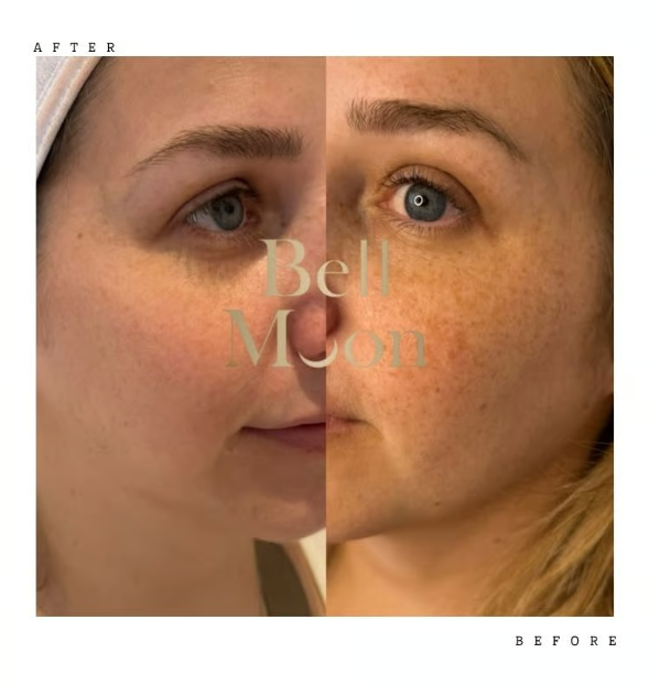 Split-face before and after at Bell Moon Aesthetics: sun-related freckles and pigmentation on the cheek cleared after treatment, three-quarter view